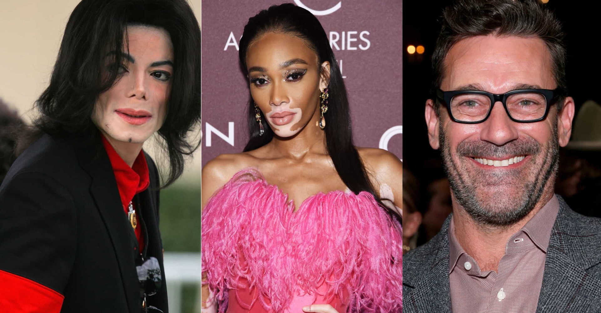 Celebrities who have vitiligo