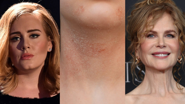 Eczema and celebrities who struggle with it