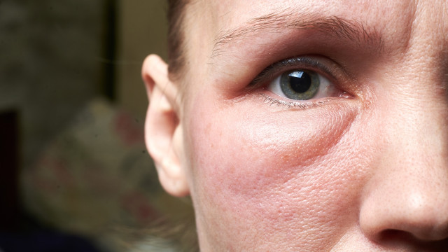 The potential reasons why your face looks swollen