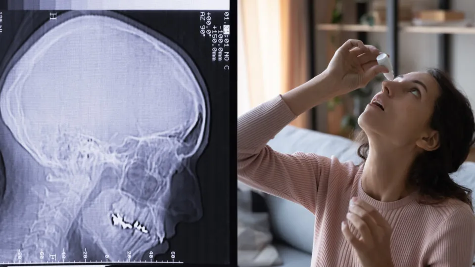 Das Sjögren-Syndrom: Die Ursache für trockene Augen und Mund?