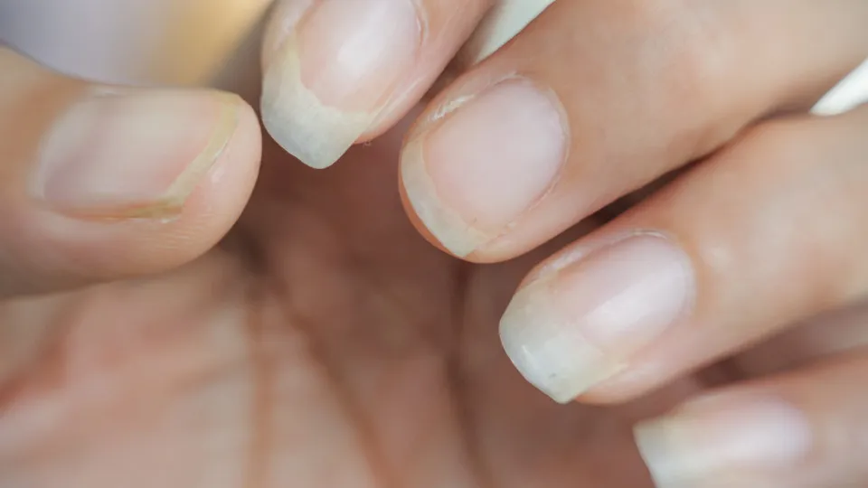 What your nails say about your health