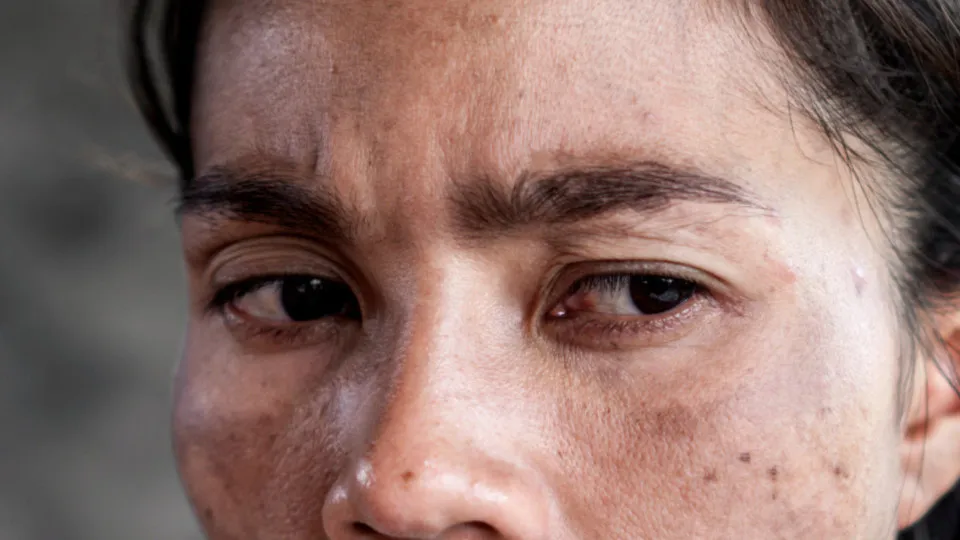 Vše, co potřebujete vědět o melasmě