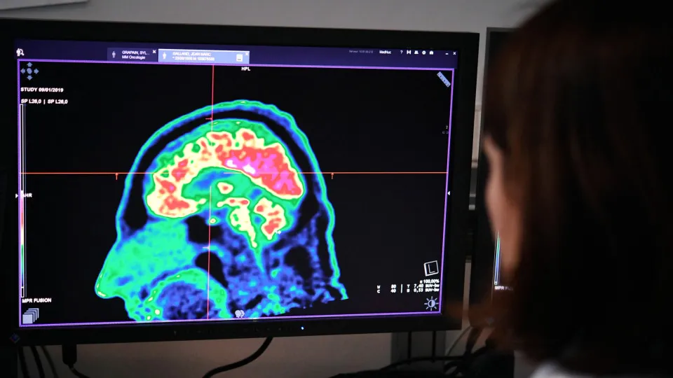 ¿Qué tan distinto es el cerebro del hombre y la mujer?