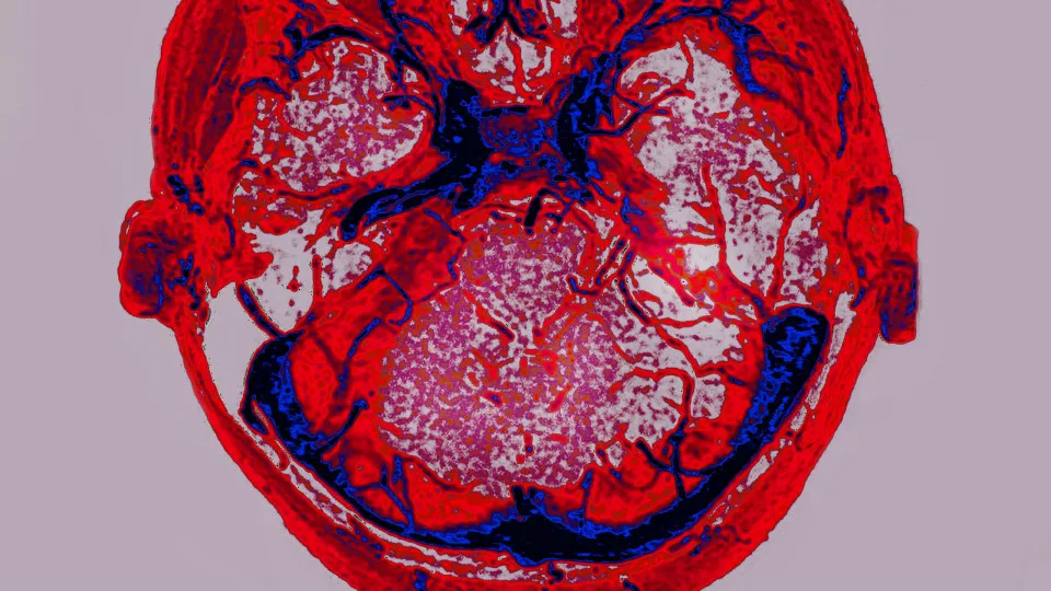 What are the most dangerous types of brain bleeds?