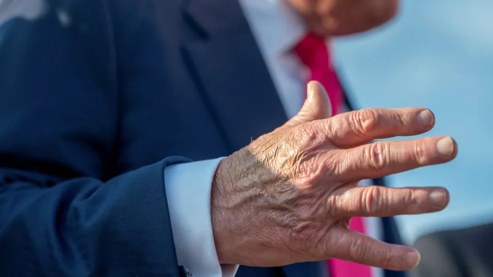 Trump diagnosed with chronic venous insufficiency