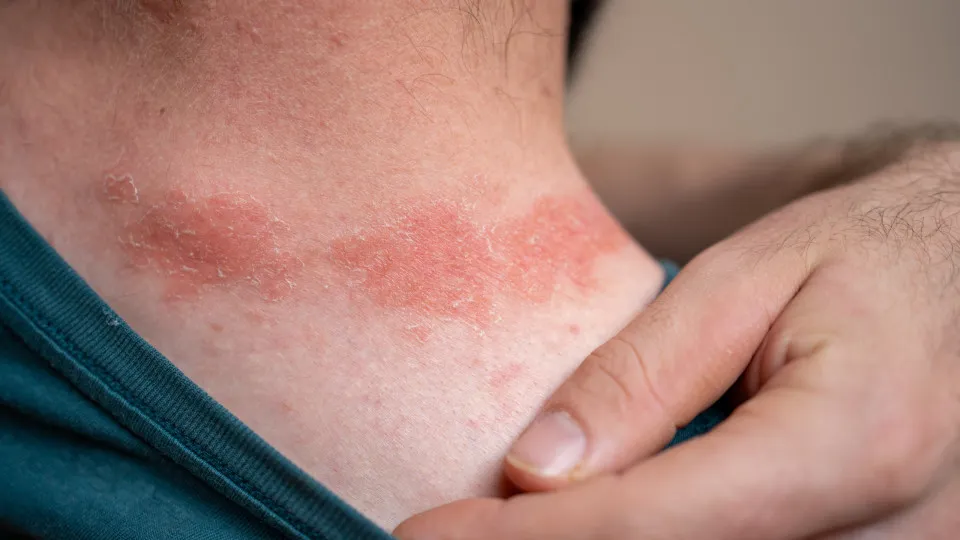 If you have these symptoms, you could be allergic to the sun