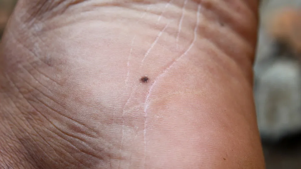 Unexpected places you can get skin cancer