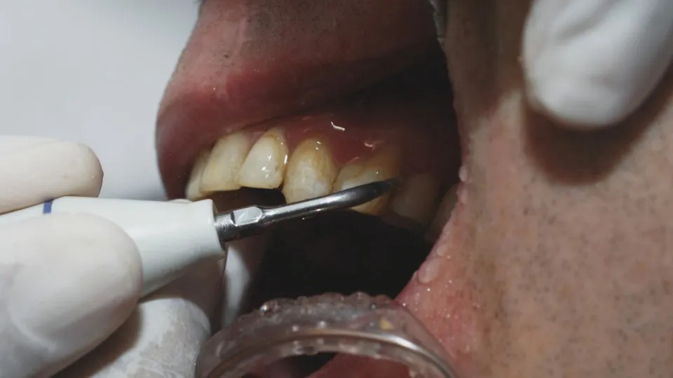 Foods and drinks that are staining your teeth