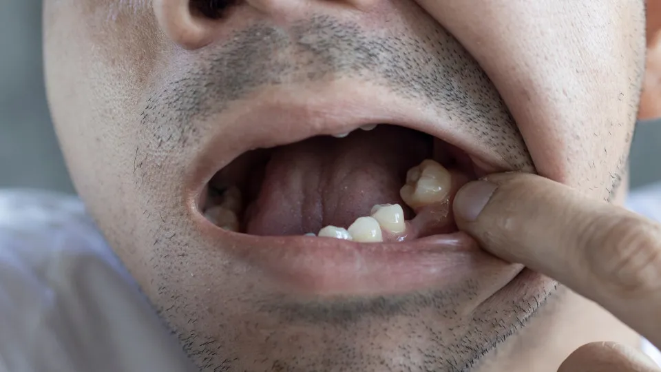 What causes teeth to fall out?