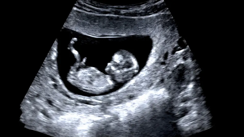 Prééclampsie et éclampsie : ce qu'il faut savoir lors de votre grossesse