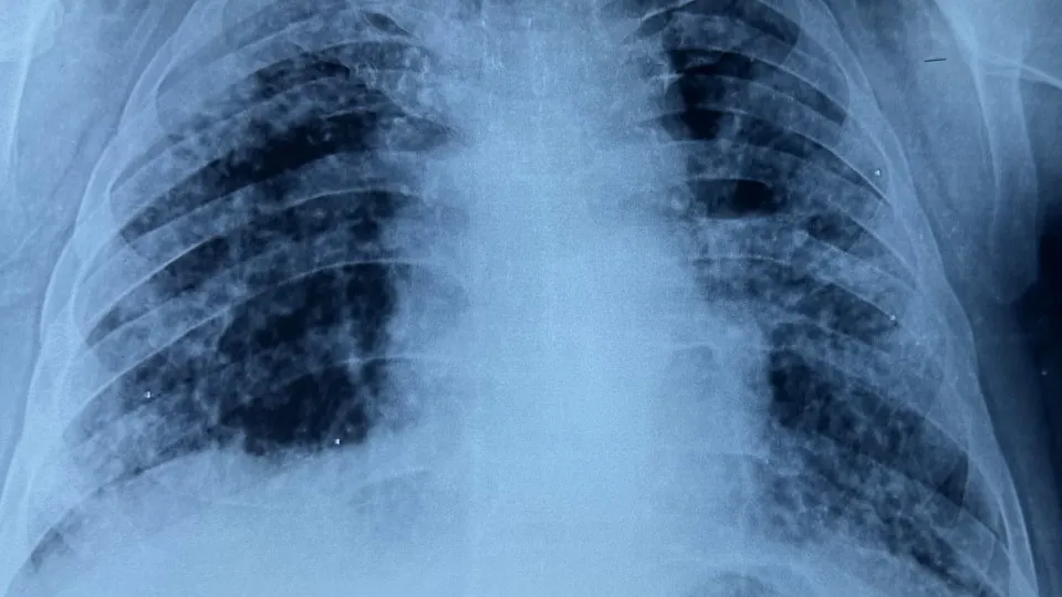 What is silicosis, and which are the industries most at risk?
